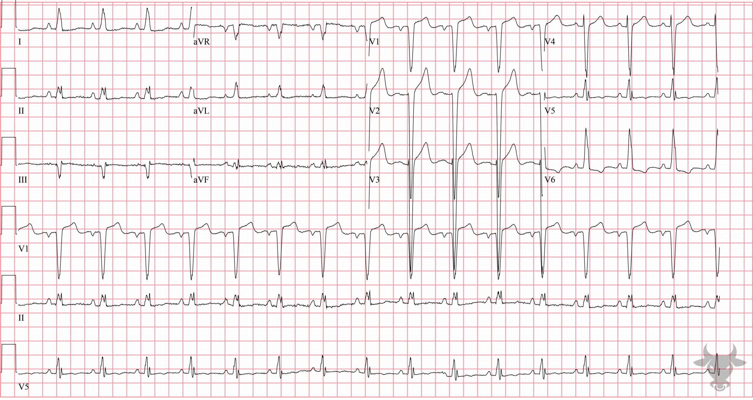 ECG Showing Left Ventricular Hypertrophy