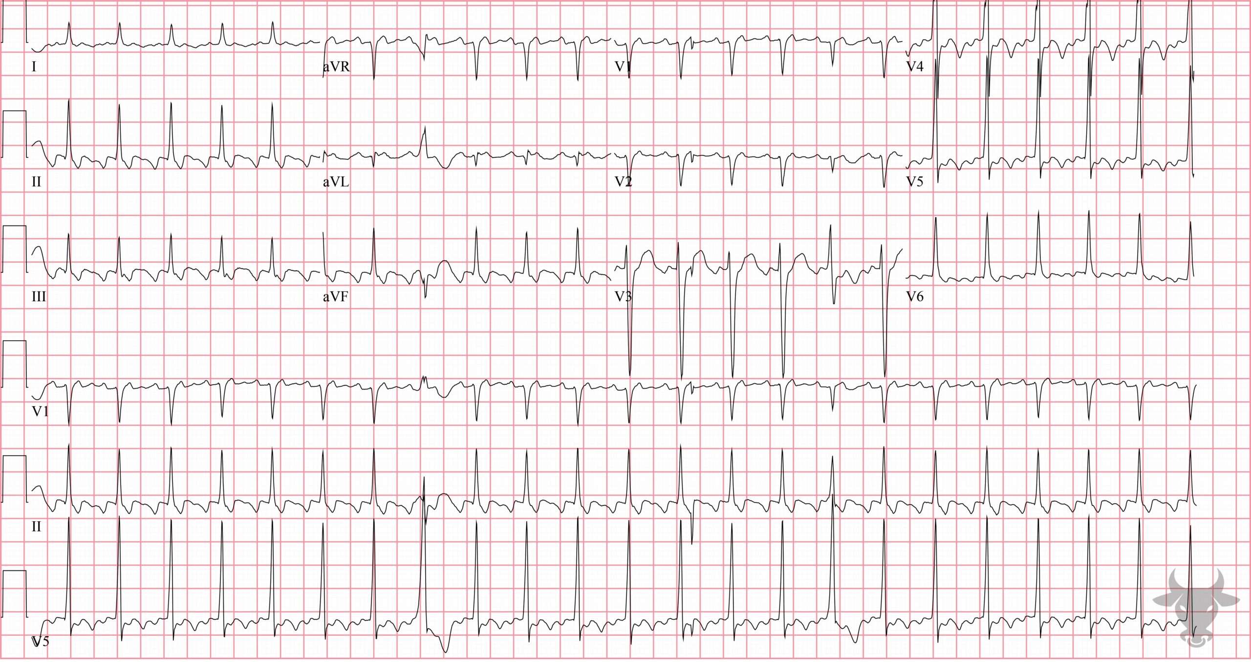 ECG Showing Atrial Flutter