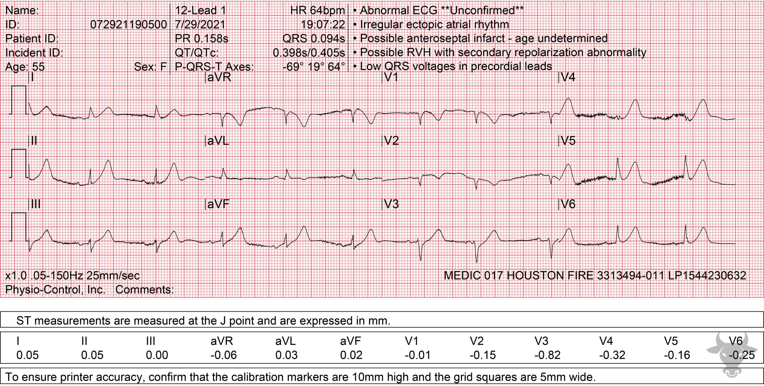 ECG Showing Hyperacute T Waves