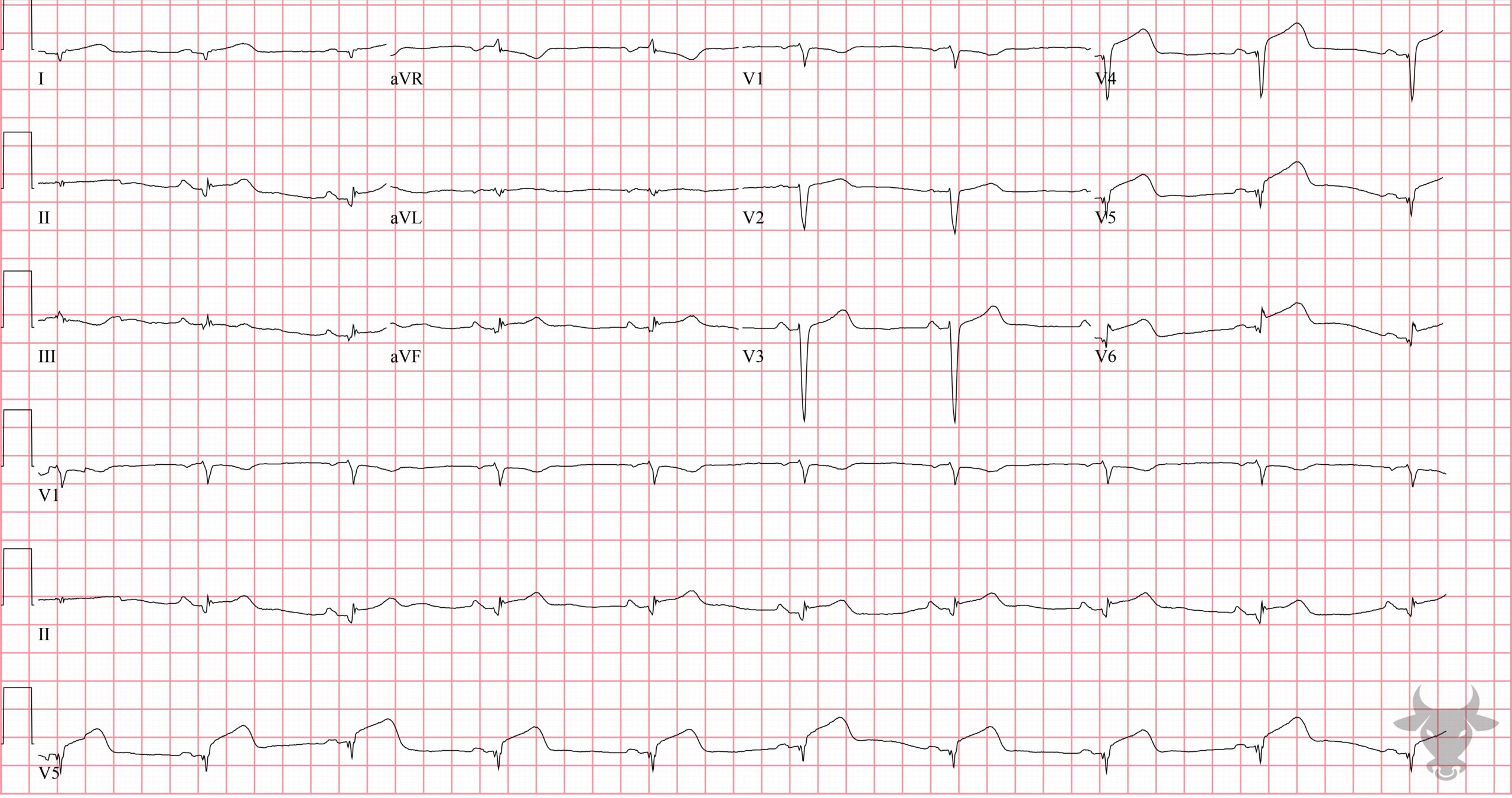 ECG Showing ST-elevation Myocardial Infarction