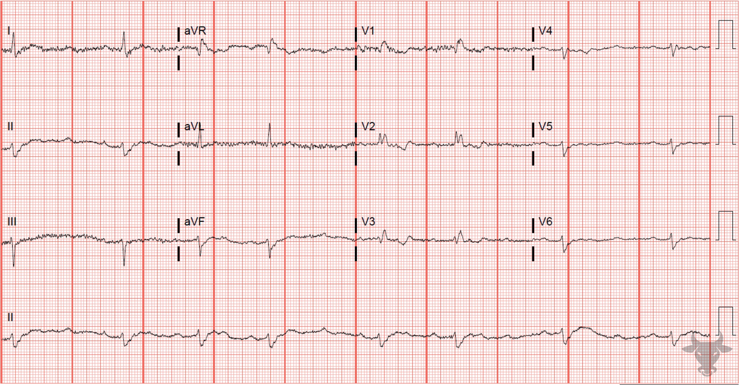 ECG Showing Second Degree Atrioventricular Block - Mobitz II