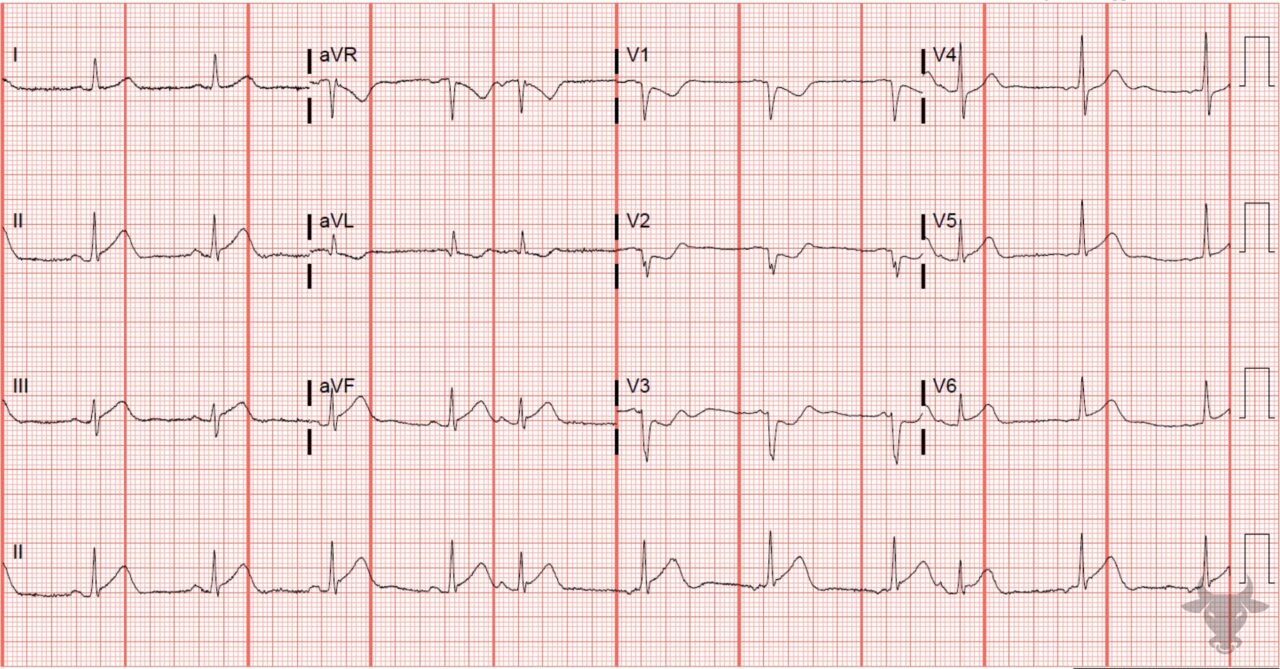 ST-elevation Myocardial Infarction | ECG Stampede