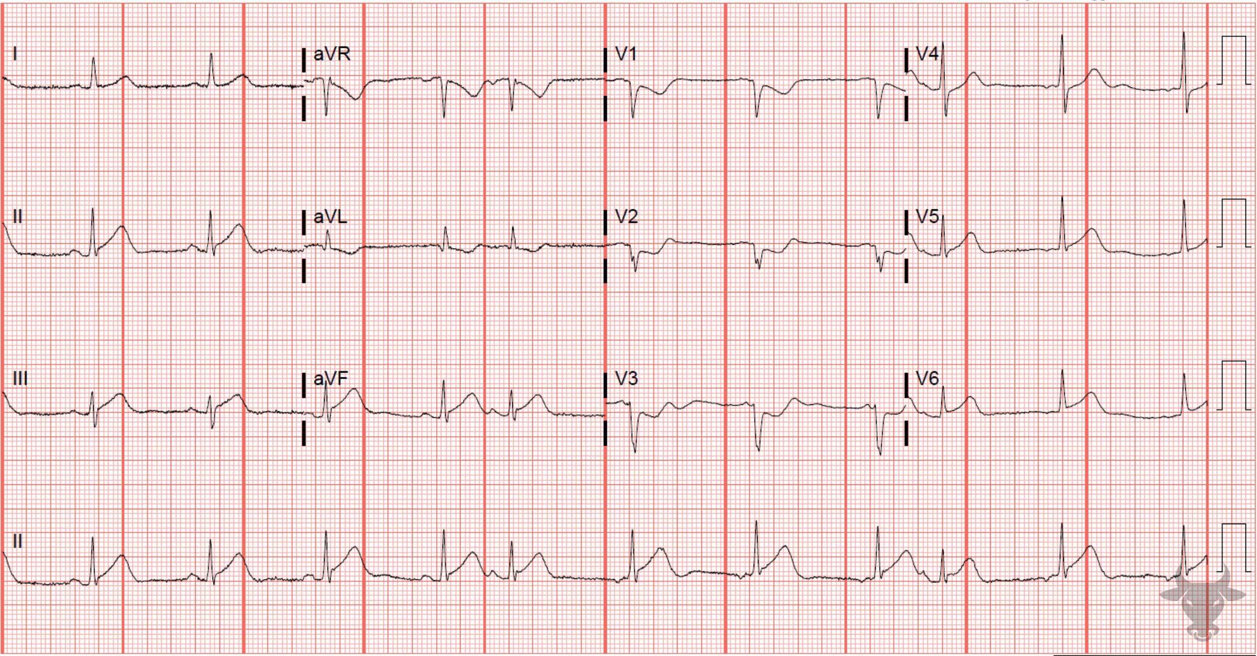 ECG Showing ST-elevation Myocardial Infarction