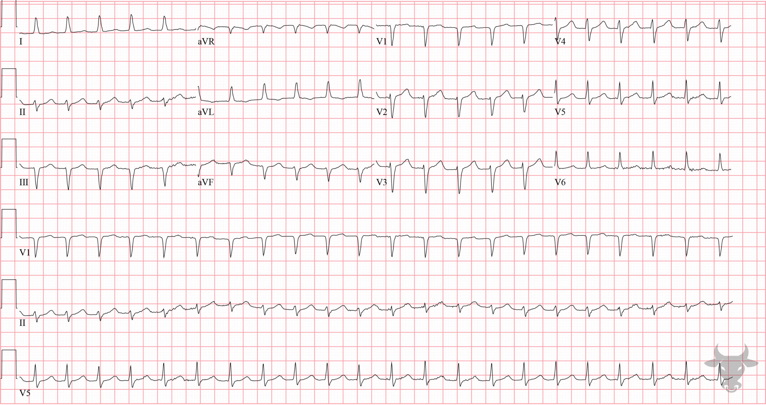 ECG Showing Atrioventricular Nodal Reentrant Tachycardia