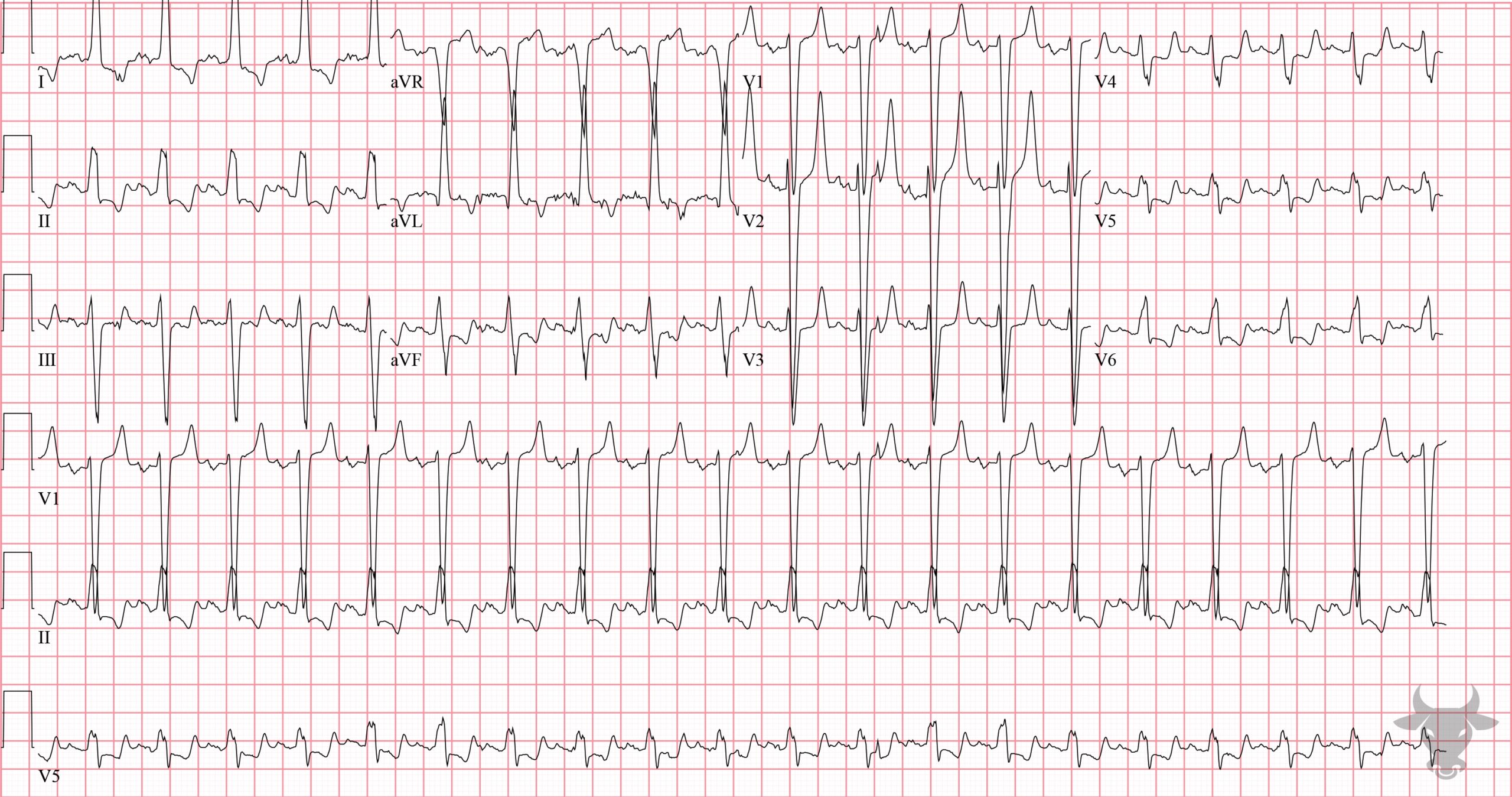 ECG Showing Hyperkalemia