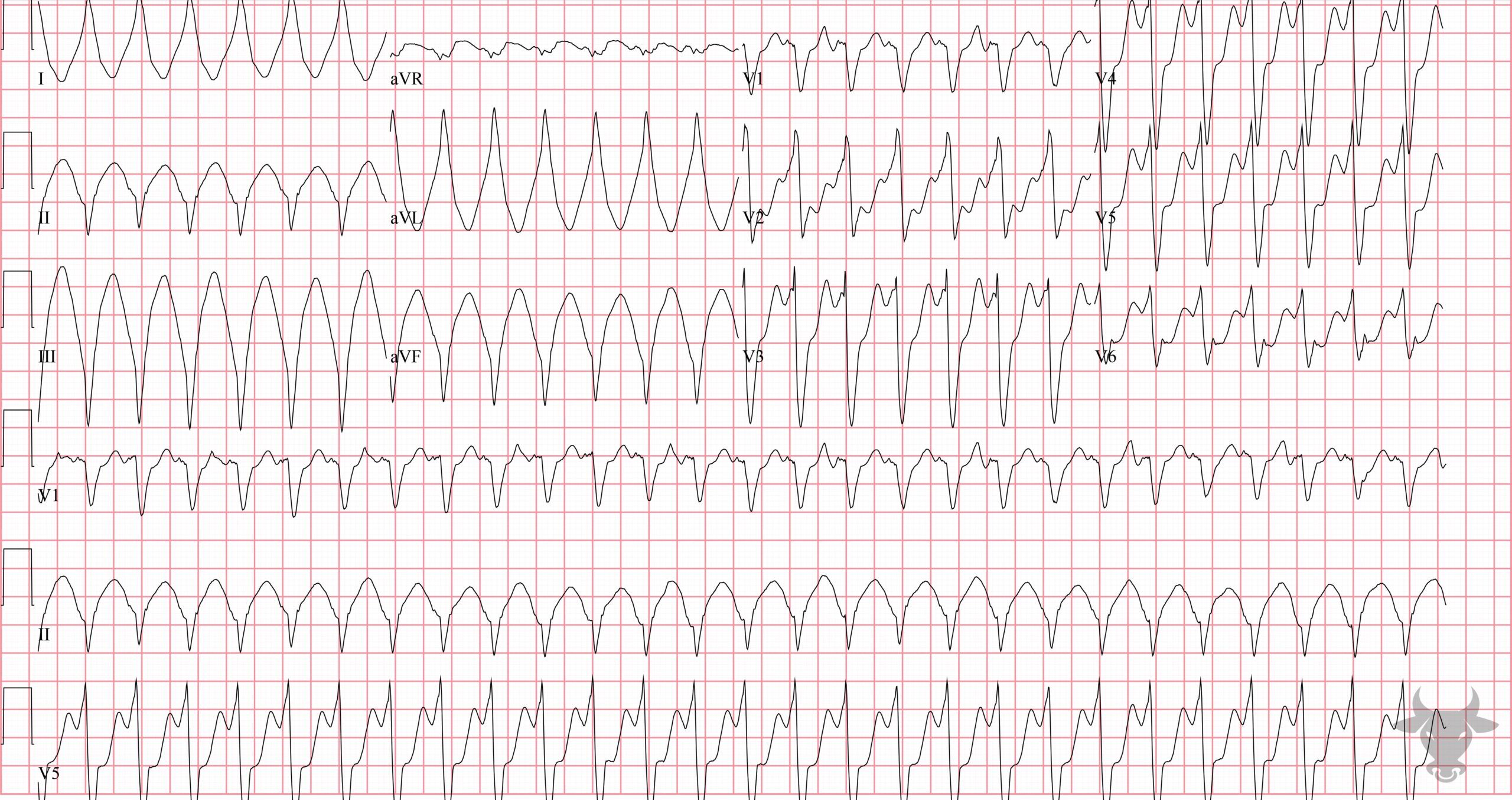 ECG Showing Ventricular Tachycardia