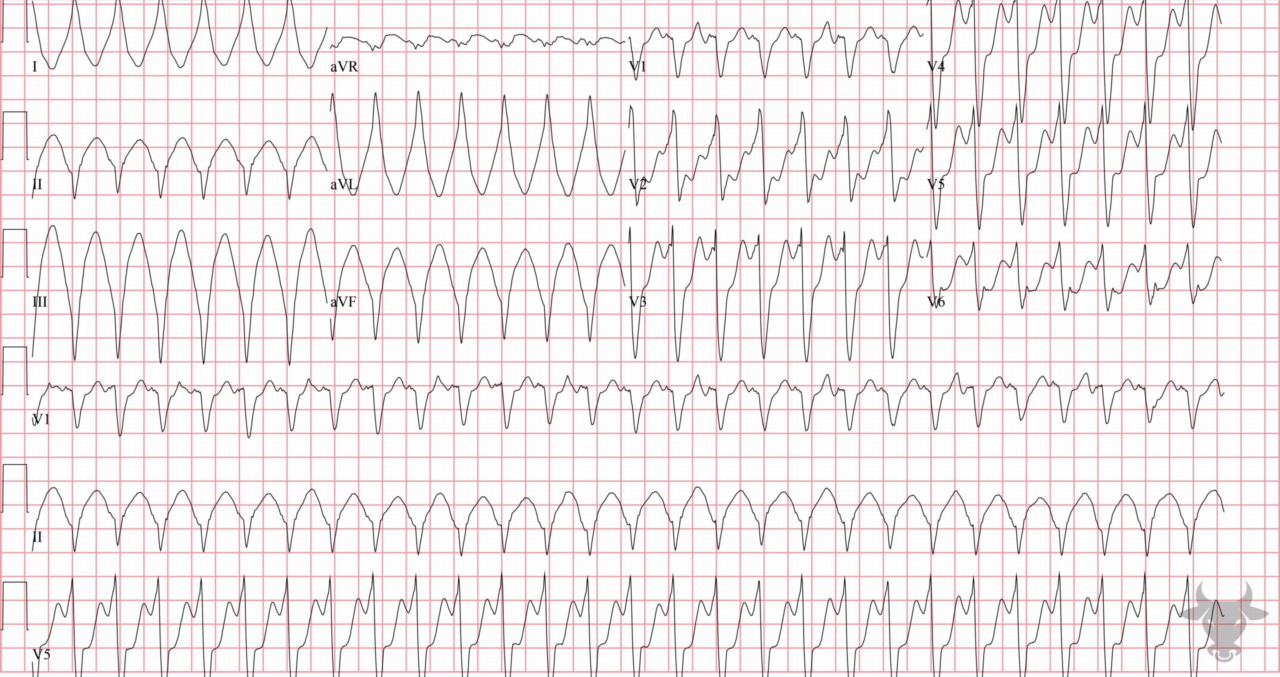 ECG Showing Ventricular Tachycardia
