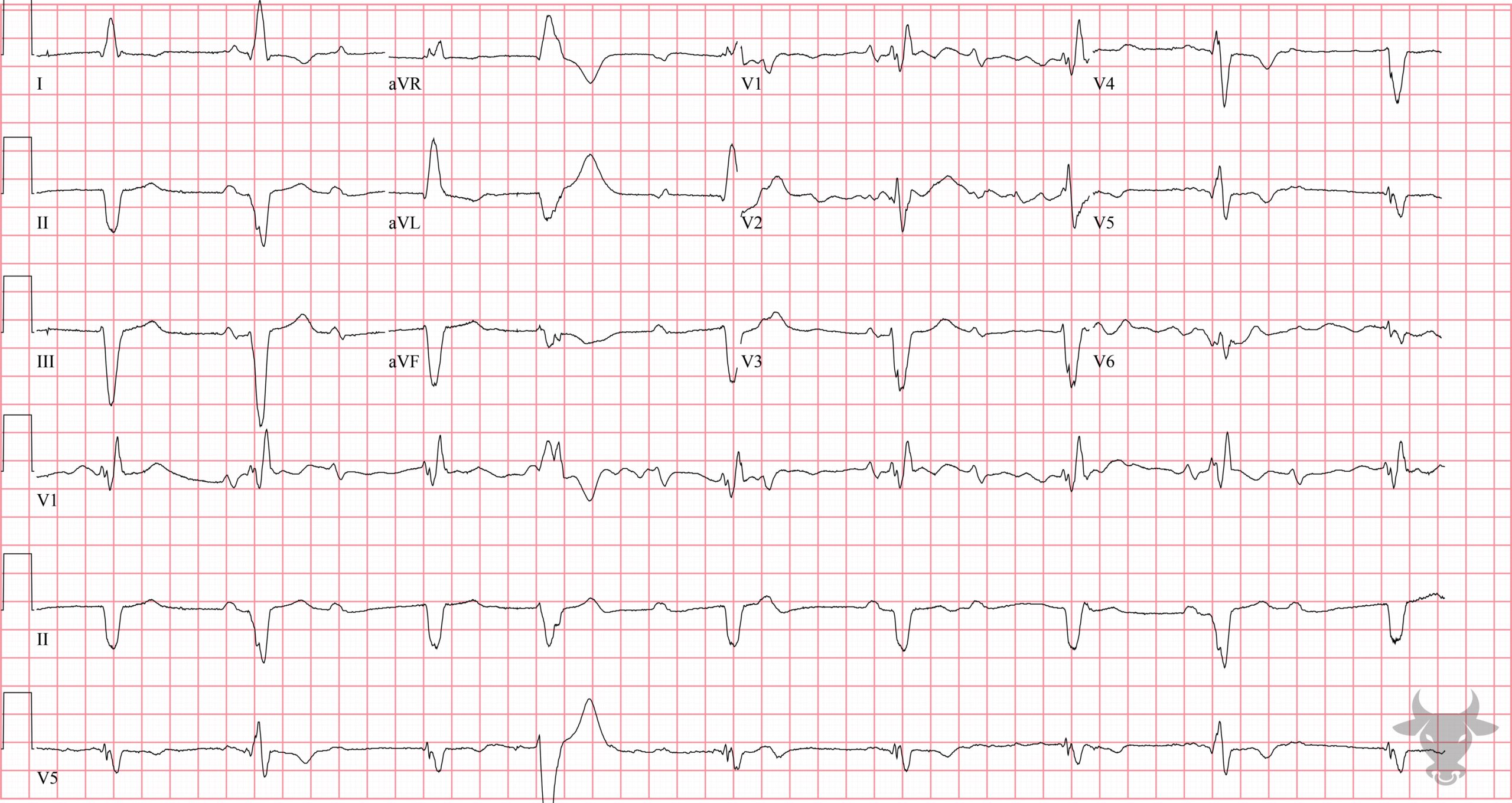 ECG Showing Second Degree Atrioventricular Block