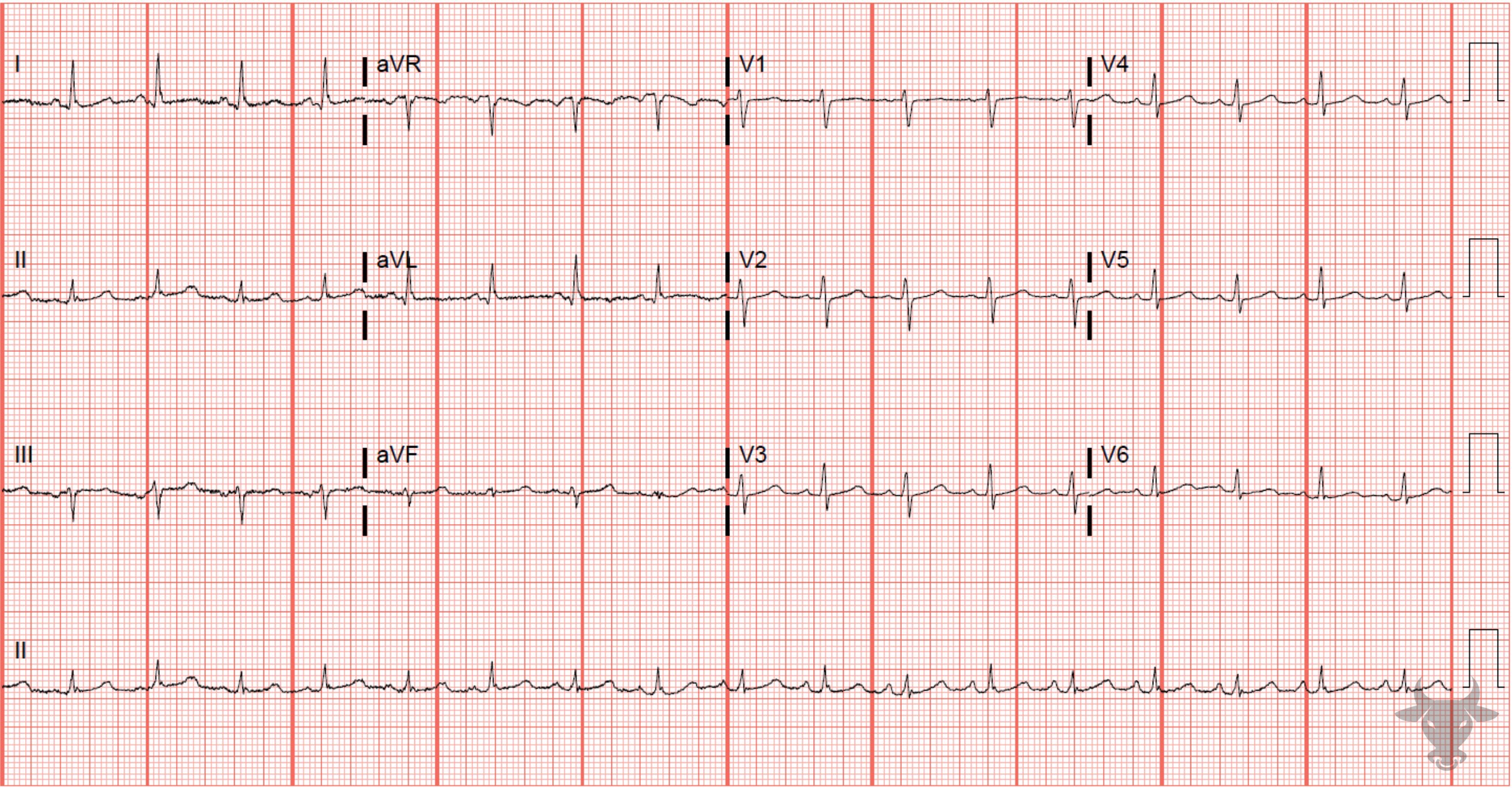 ECG Showing Atrial Flutter