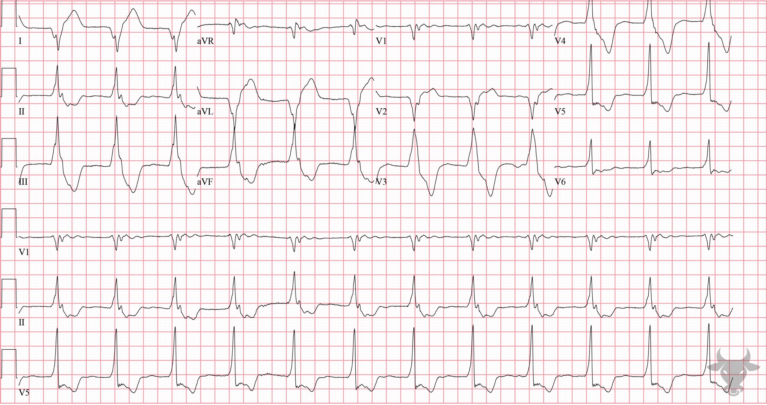 ECG Showing Accelerated Idioventricular Rhythm