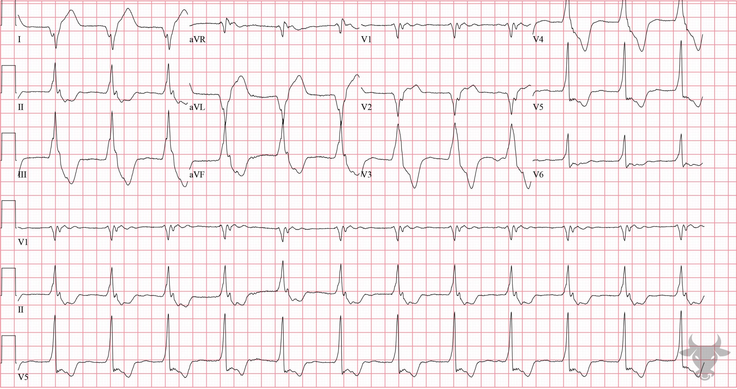 ECG Showing Accelerated Idioventricular Rhythm