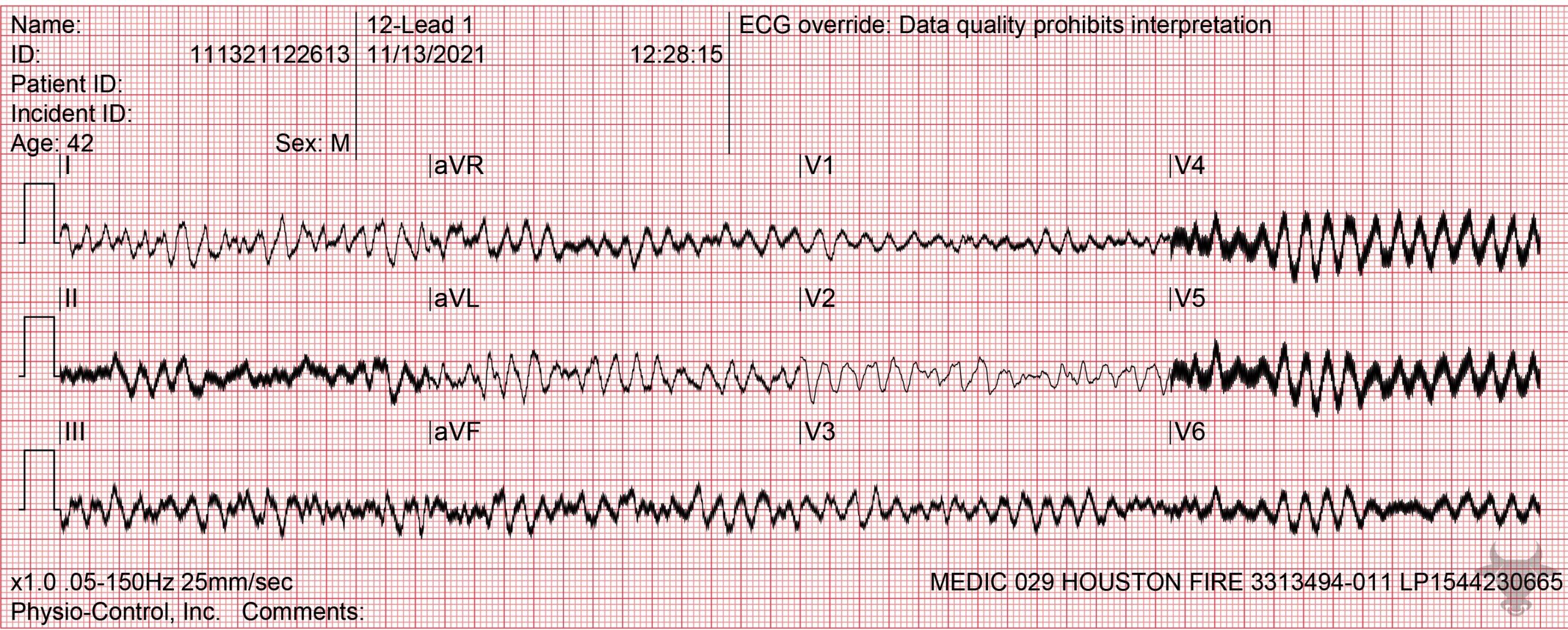 ECG Showing Ventricular Fibrillation