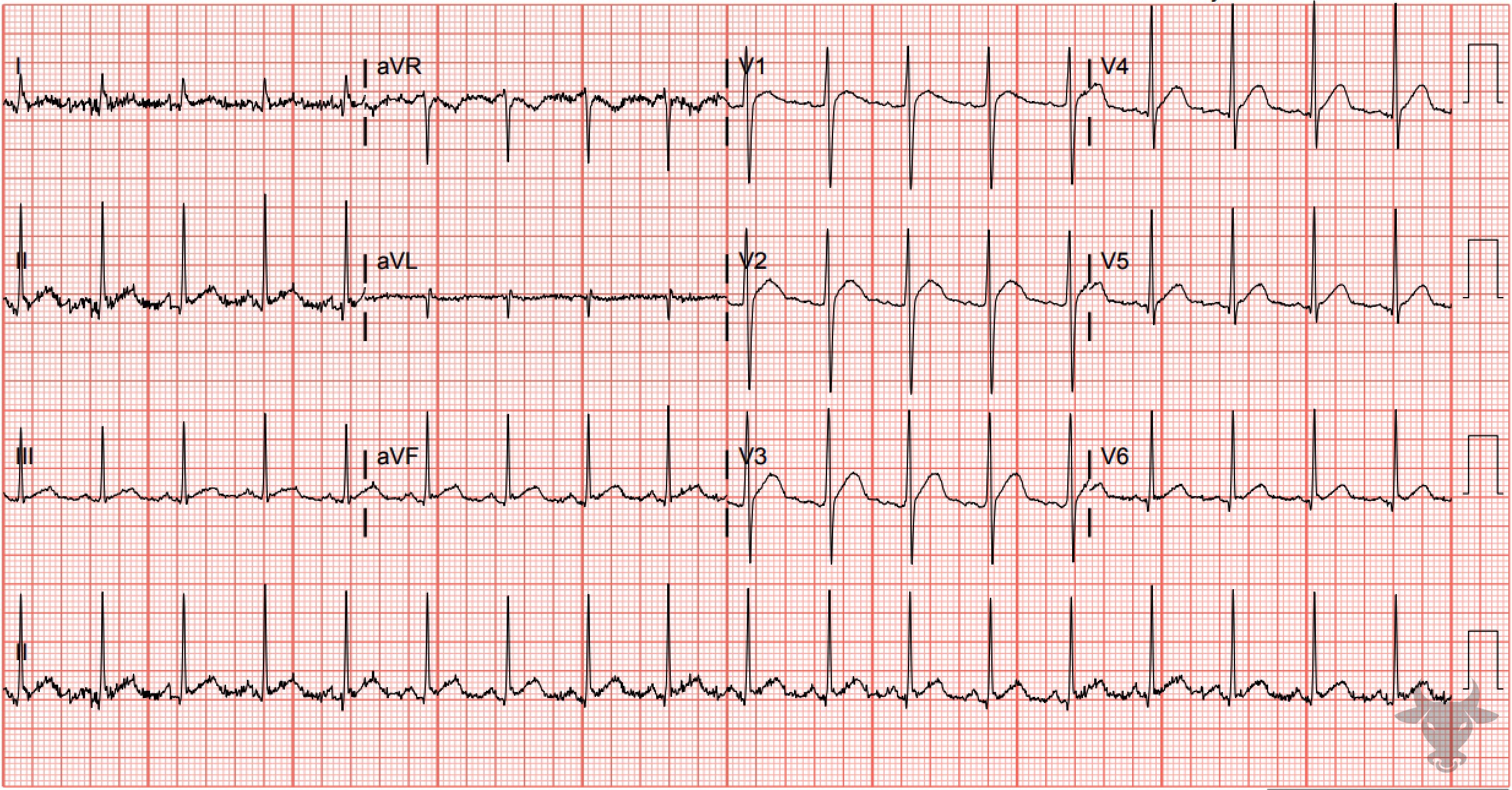 ECG Showing Hypercalcemia