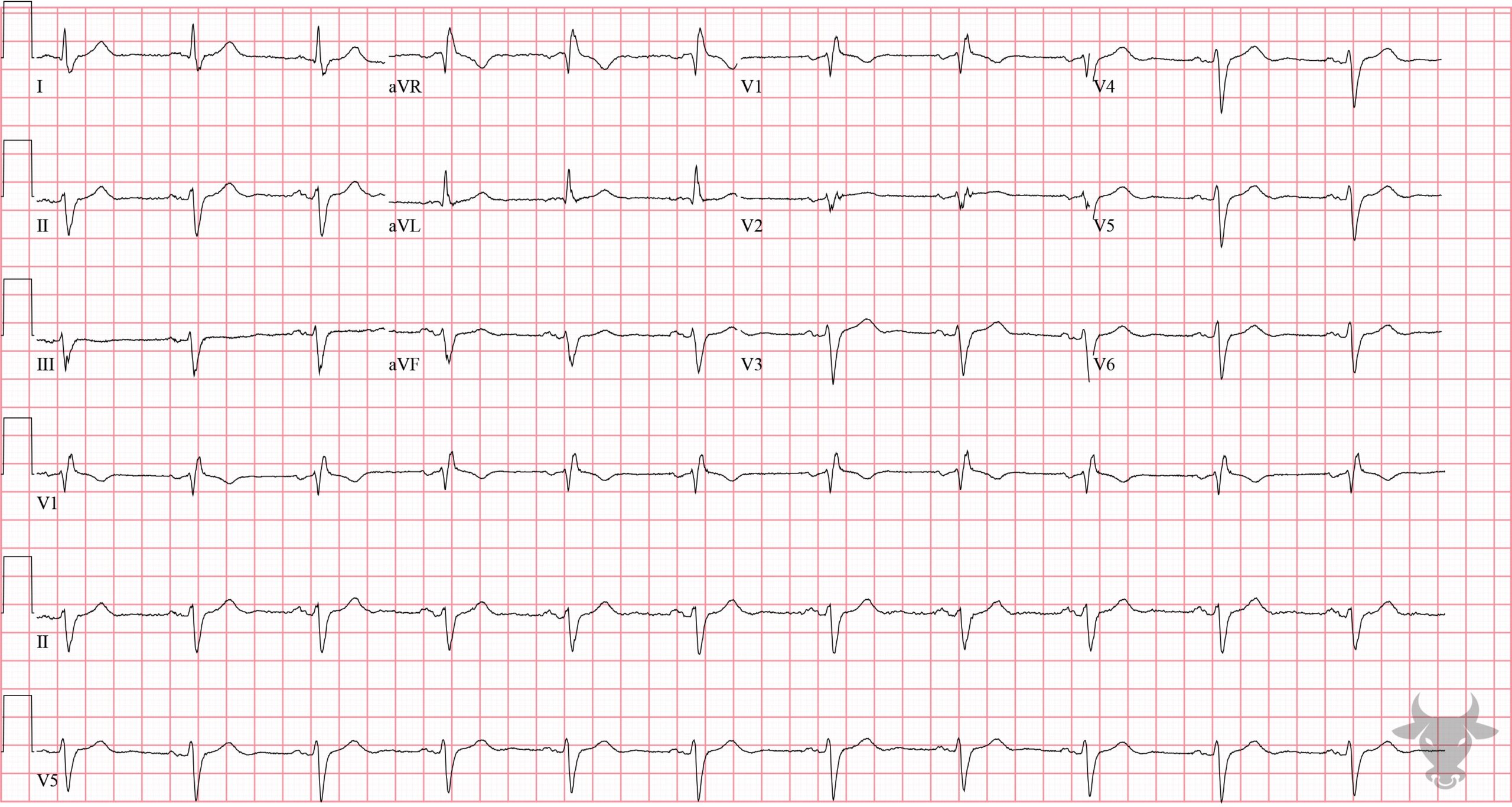 ECG Showing Bifascicular Block