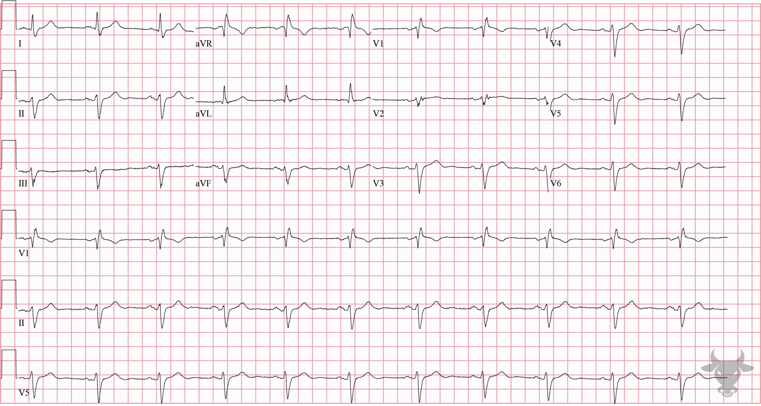 ECG Showing Bifascicular Block