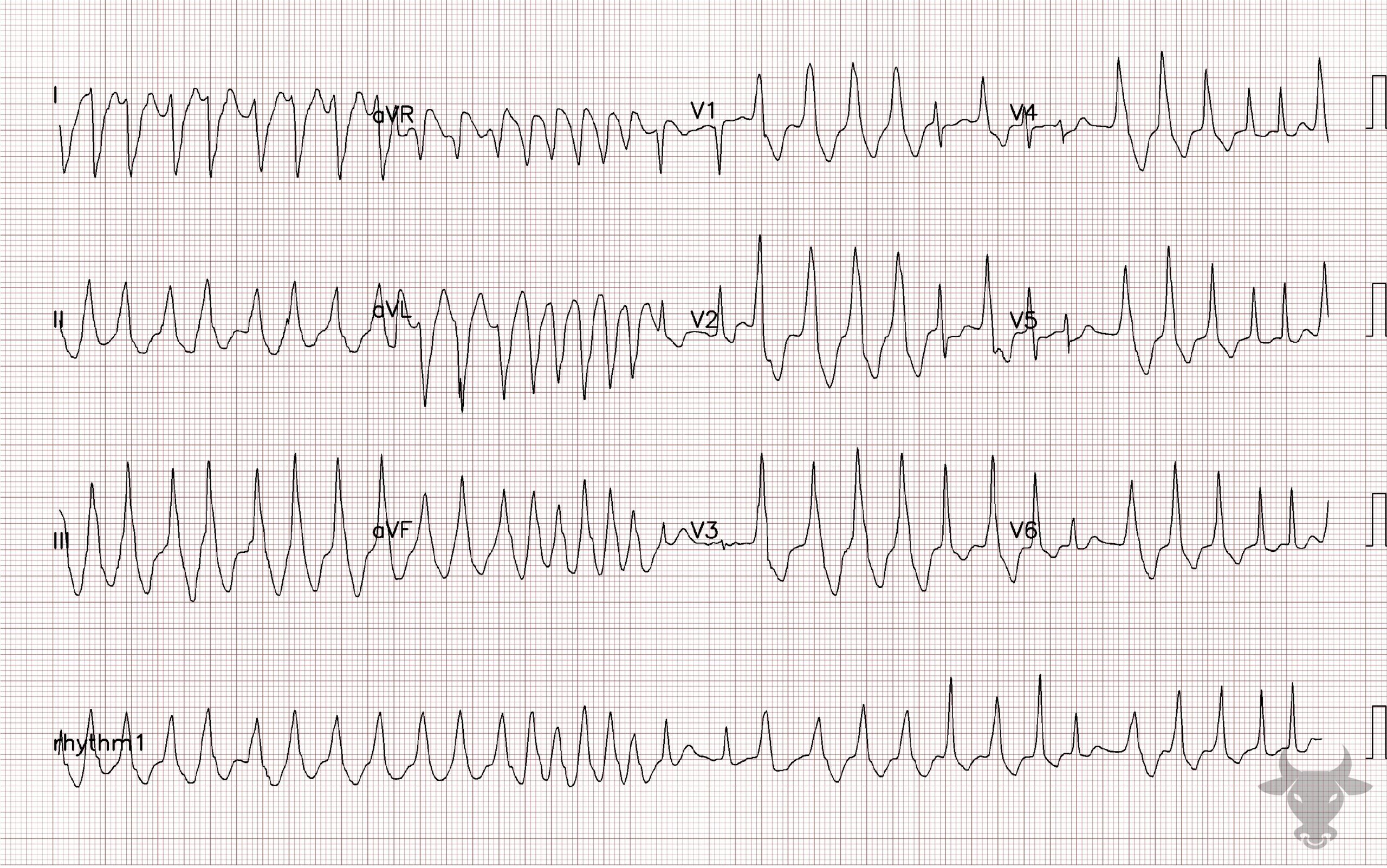 ECG Showing Atrial Fibrillation with WPW