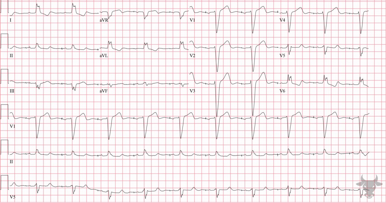 paced-rhythms-ecg-stampede