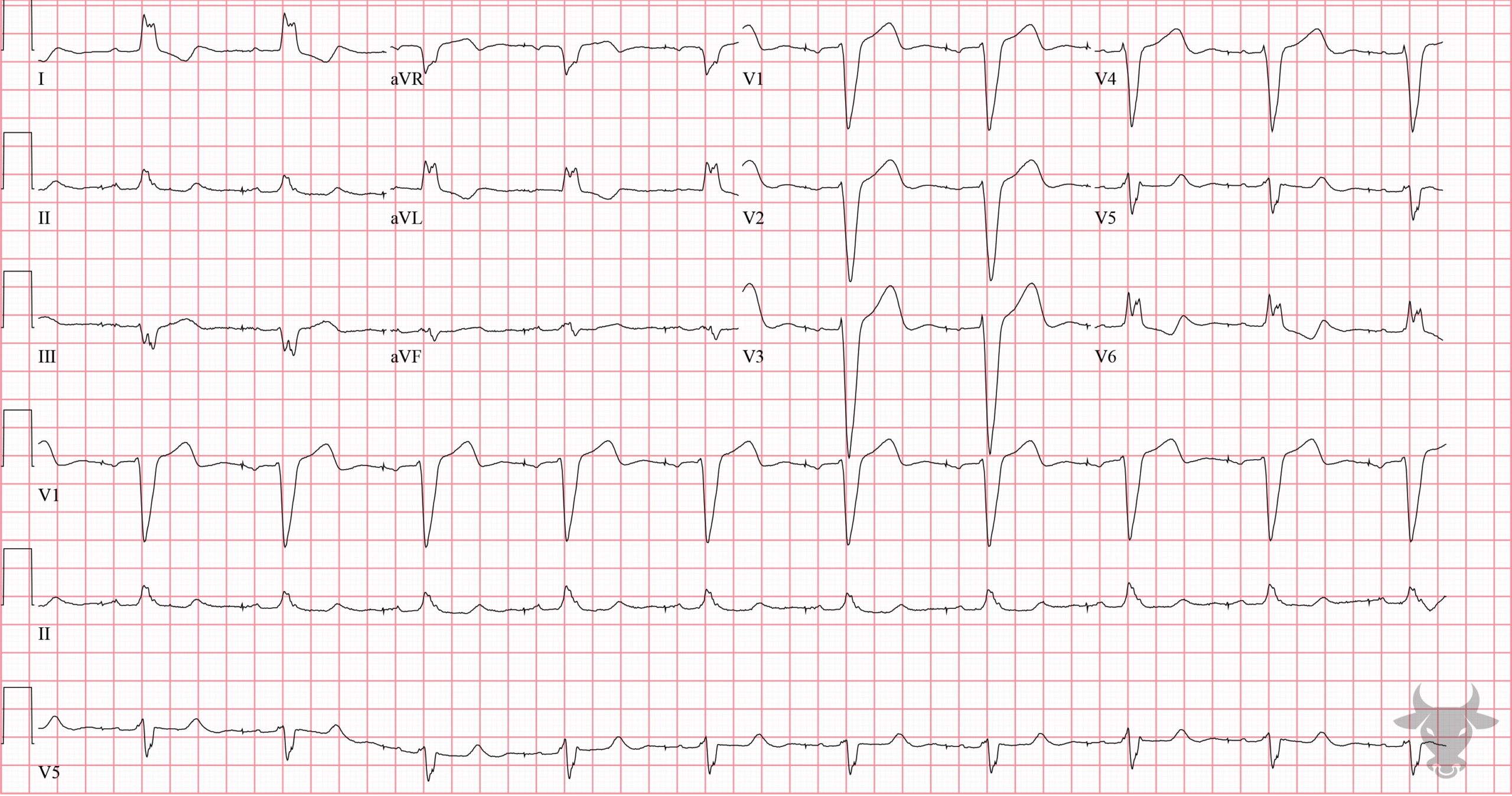 ECG Showing Paced Rhythm