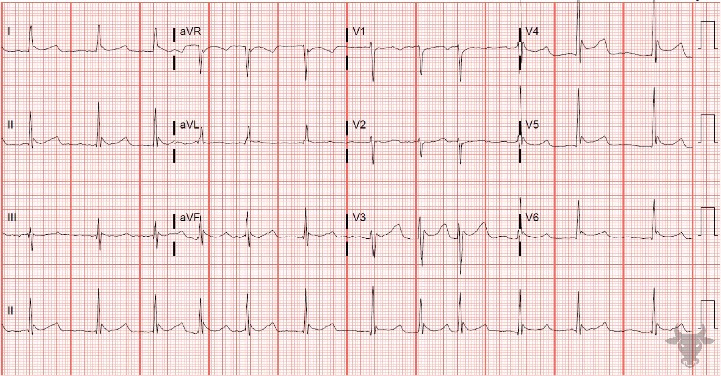 ECG Showing Hypothermia