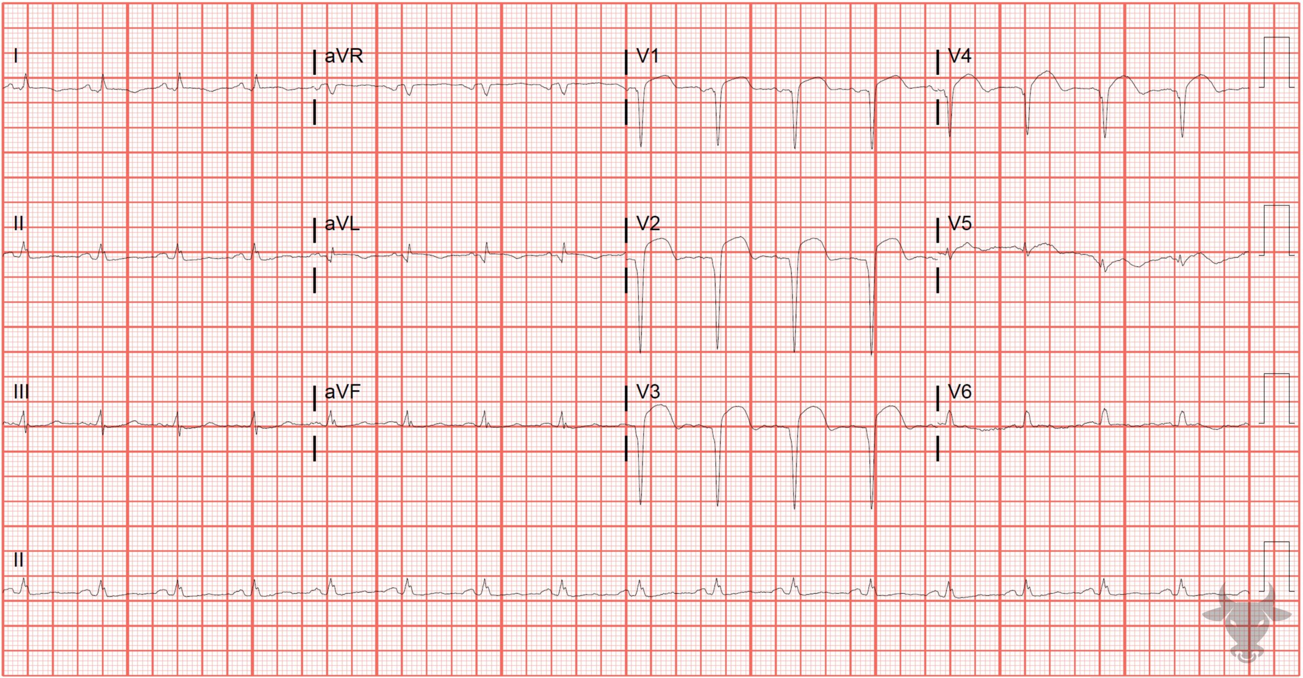 ECG Showing Left Ventricular Aneurysm