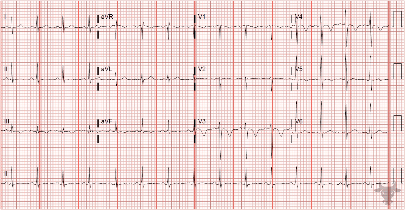 ECG Showing Right Heart Strain