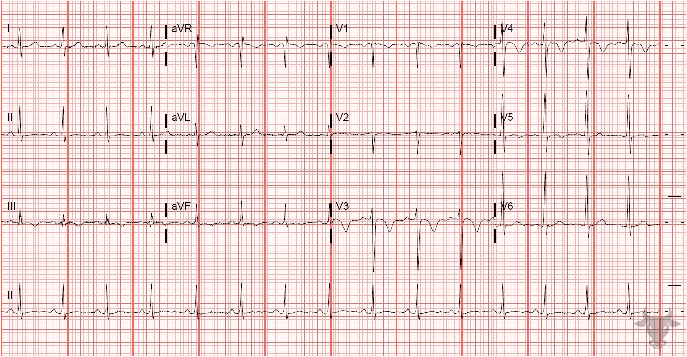 ECG Showing Pulmonary Embolism