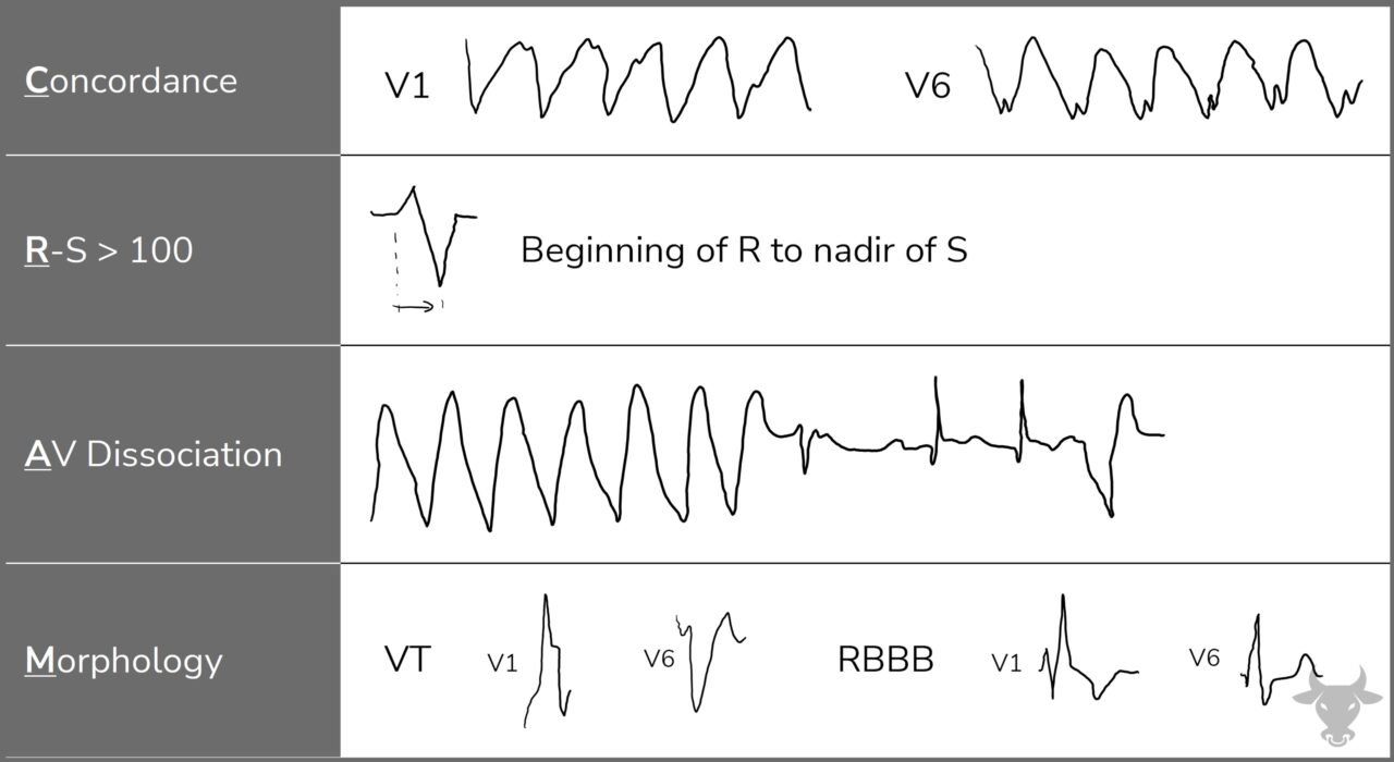 Supraventricular Tachycardia with Aberrancy ECG Stampede