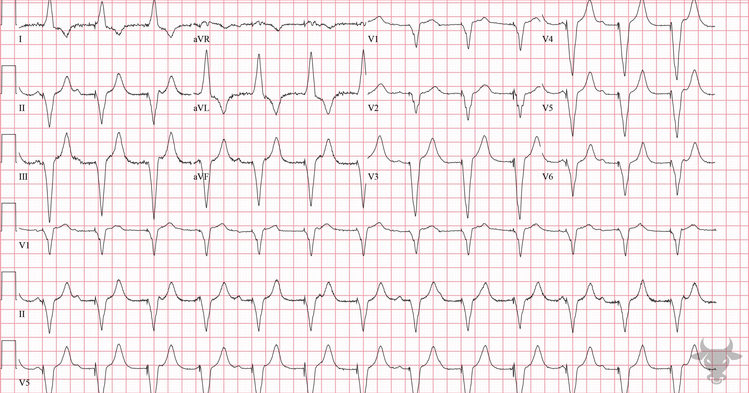 ECG Showing Paced Rhythm