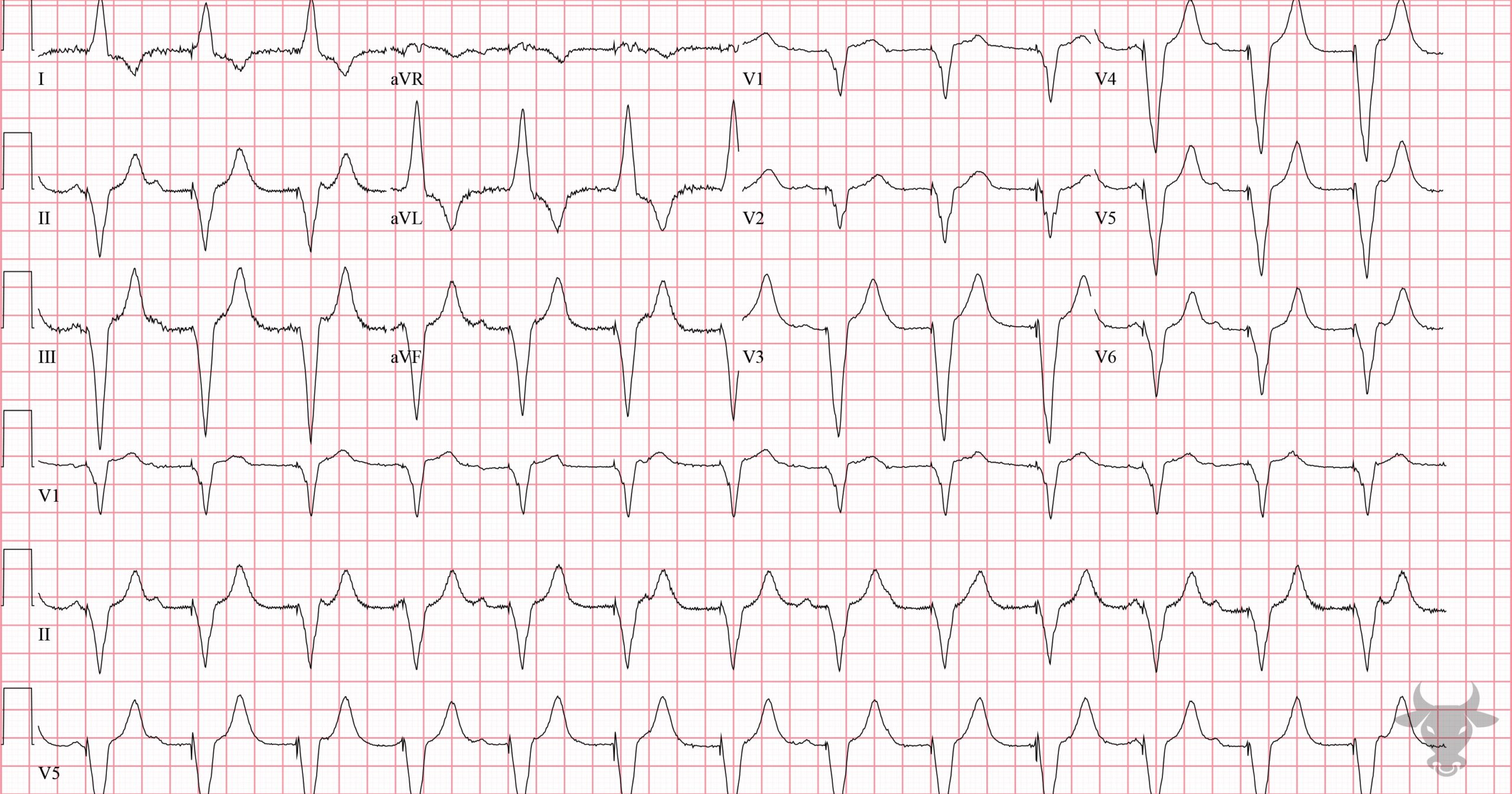 ECG Showing Paced Rhythm