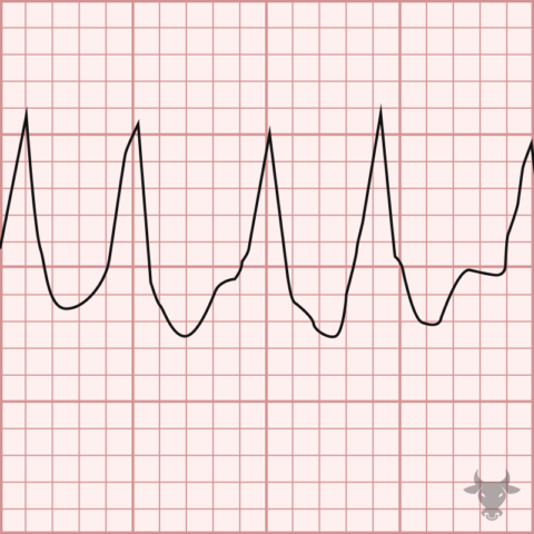 Atrial Fibrillation with WPW | ECG Stampede