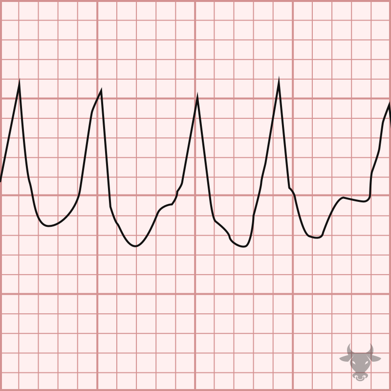 Atrial Fibrillation with WPW