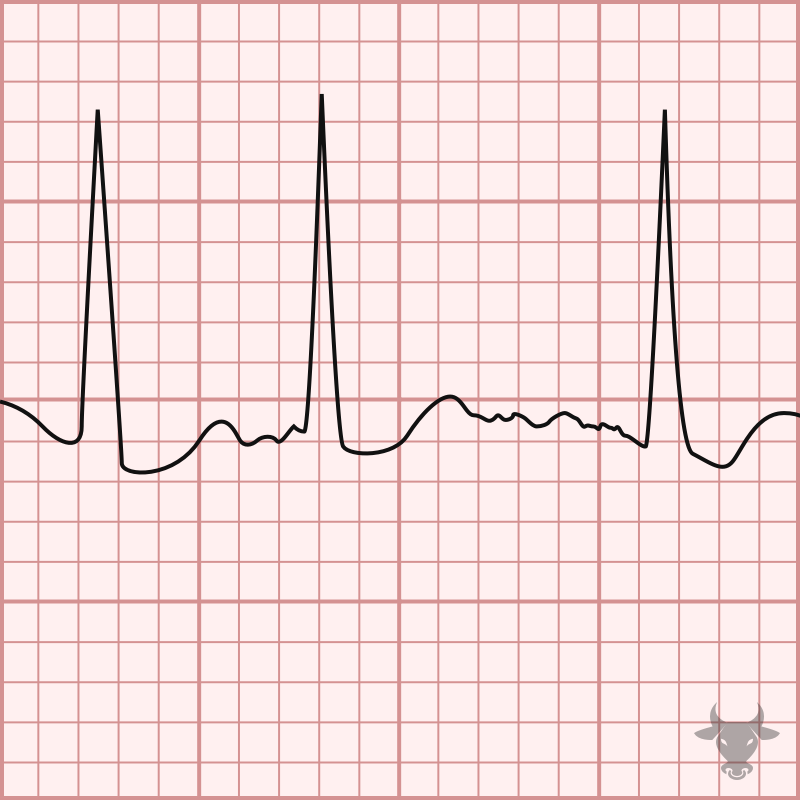 Atrial Fibrillation