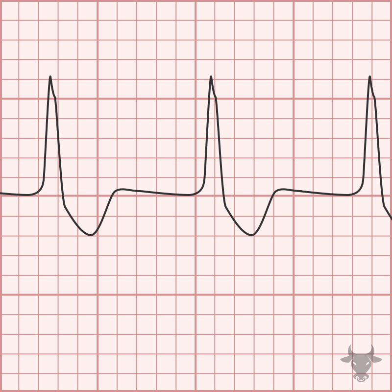 Accelerated Idioventricular Rhythm