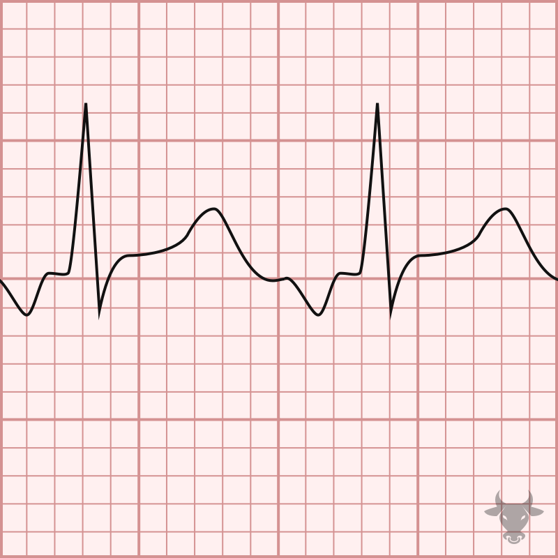 Atrial Tachycardia