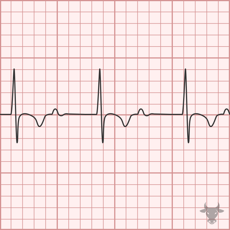 First Degree Atrioventricular Block