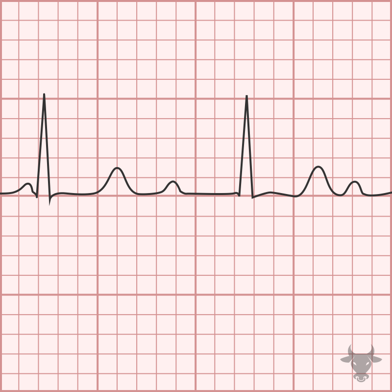 Second Degree Atrioventricular Block – Mobitz I