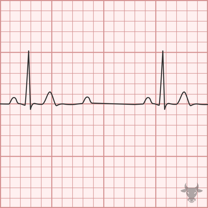 Second Degree Atrioventricular Block 2:1