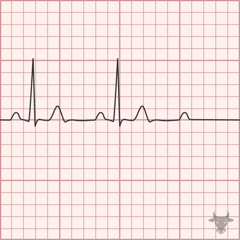 Second Degree Atrioventricular Block – Mobitz II