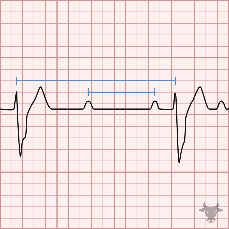 Third Degree Atrioventricular Block