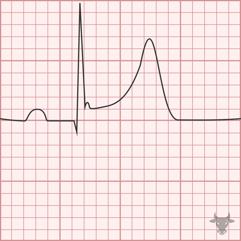 Early Repolarization