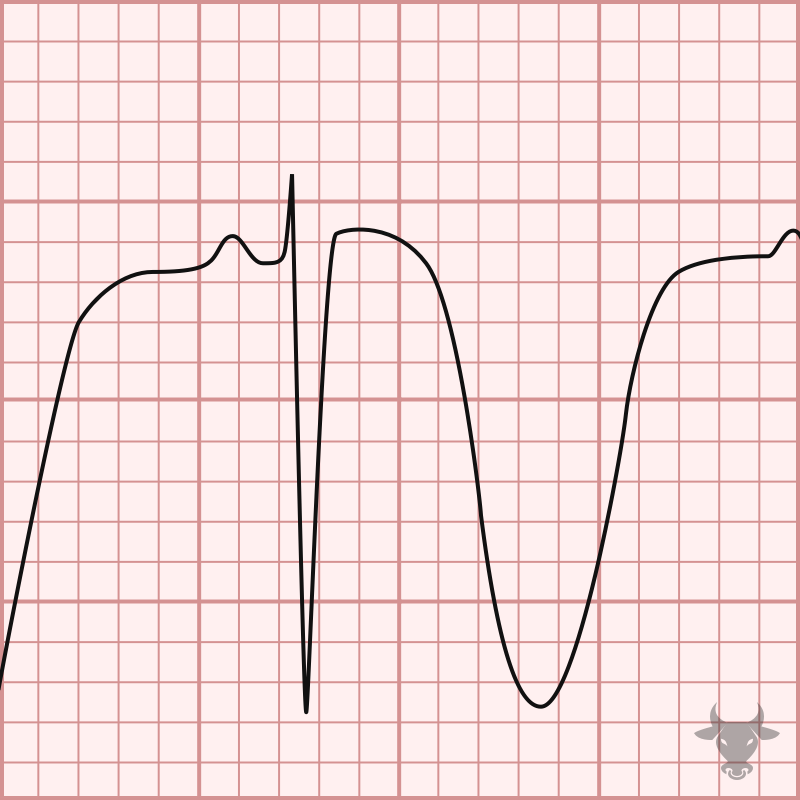 Cerebral T waves