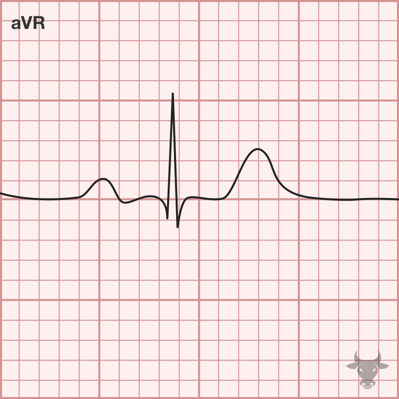 Limb Lead Reversal