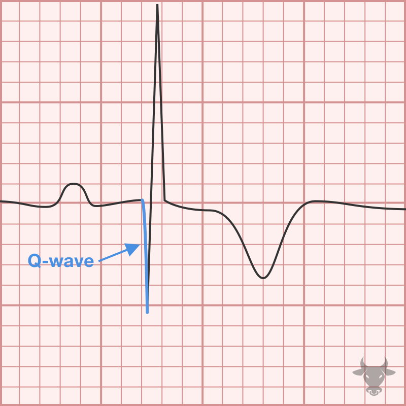 Hypertrophic Cardiomyopathy