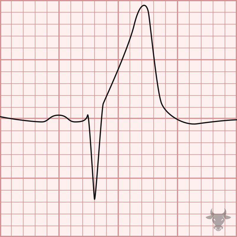 Hyperacute T Waves