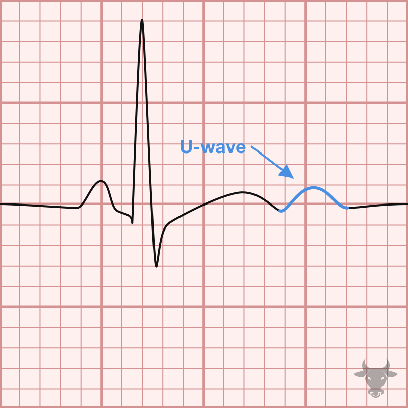 Hypokalemia