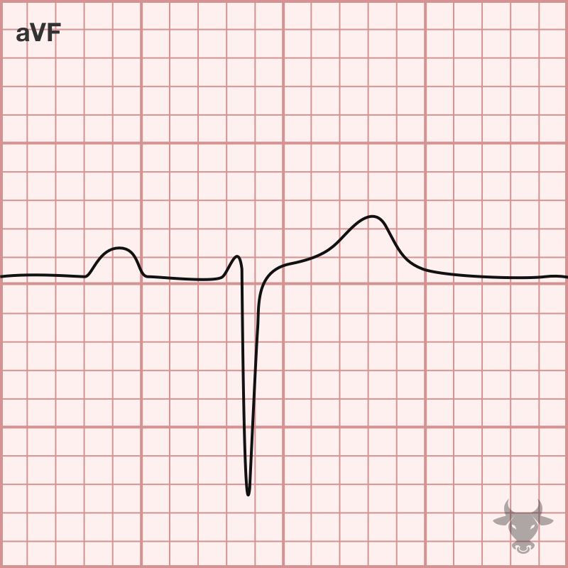 Left Anterior Fascicular Block