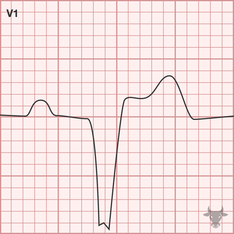 Left Bundle Branch Block