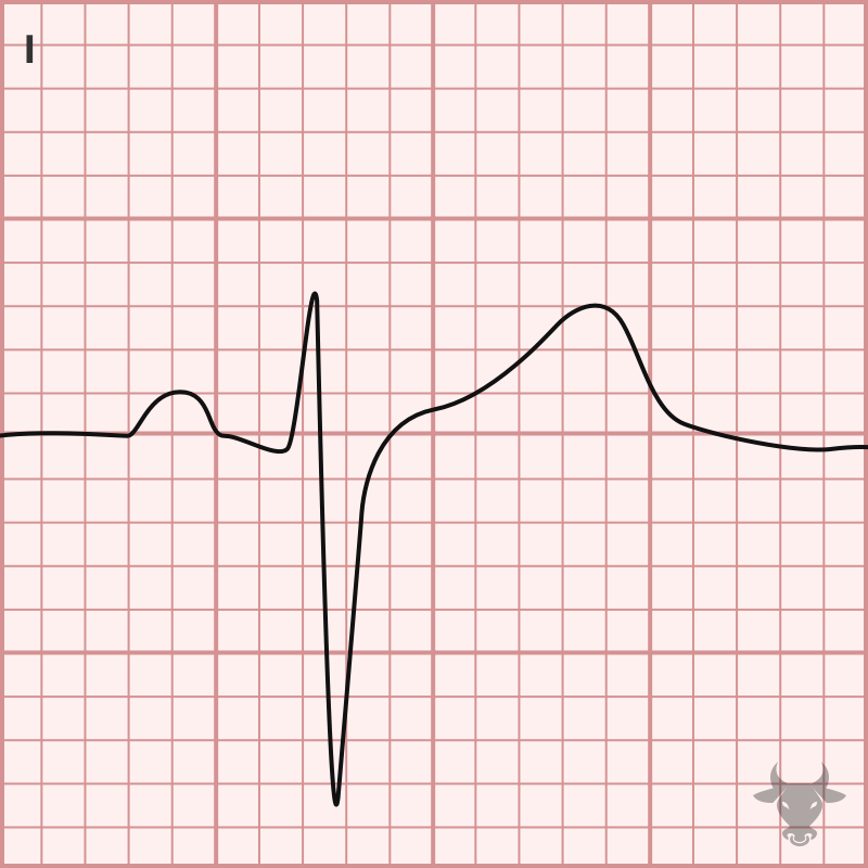 Left Posterior Fascicular Block