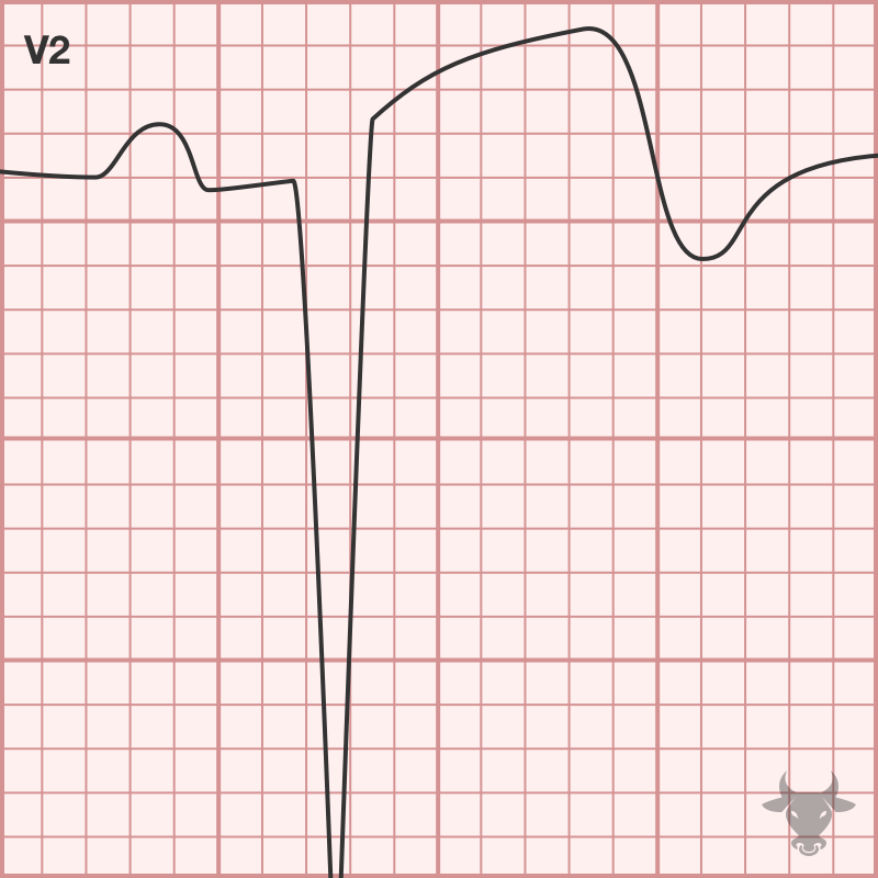 Left Ventricular Aneurysm