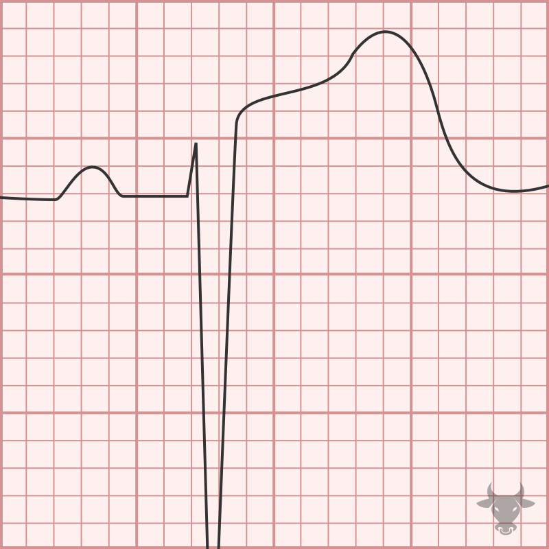 Left Ventricular Hypertrophy